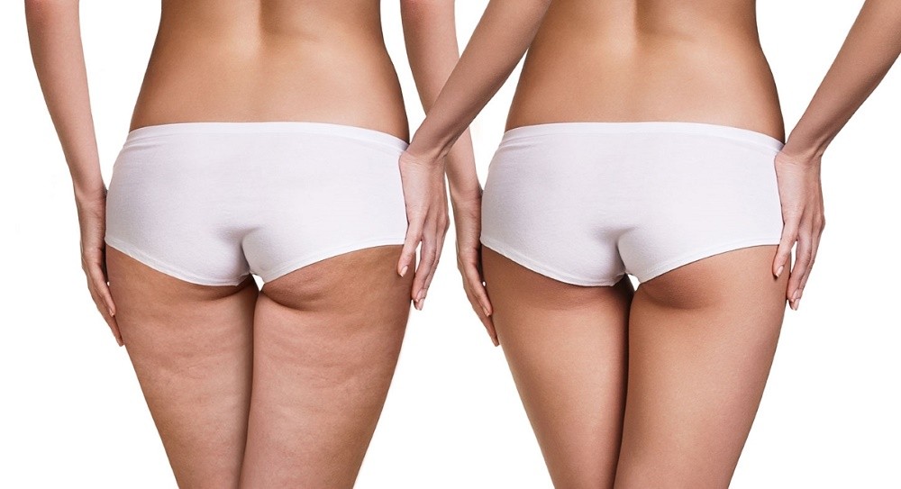 Svelti Cellushape treatment